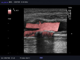 Ultrazvok vratnih žil - kalciniran plak v bulbusu in notranji karotidi